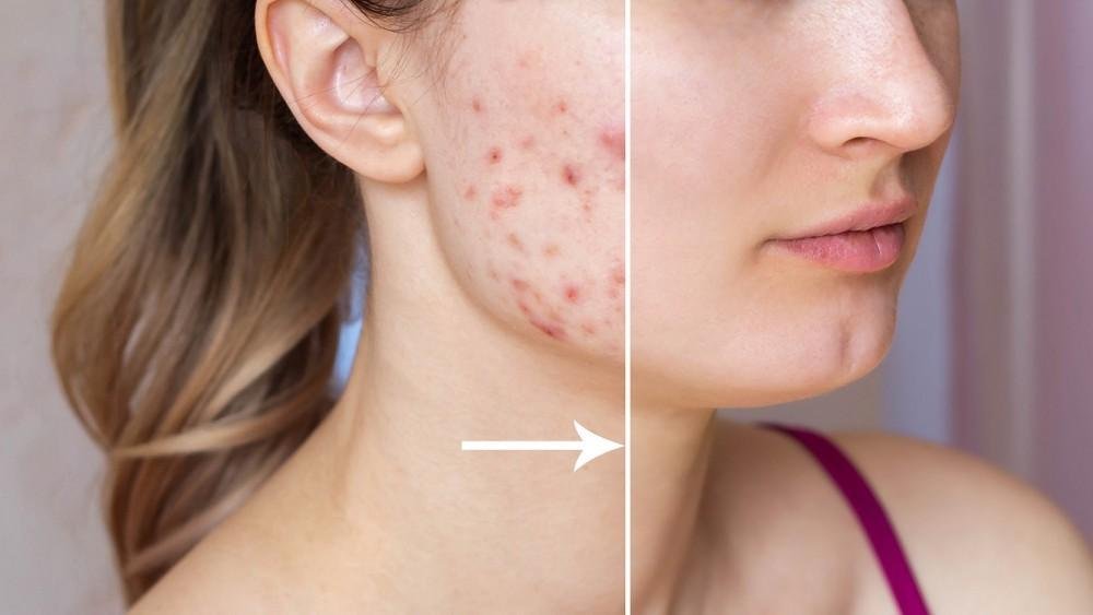 Acne and Acne Scars Treatment in Budaun