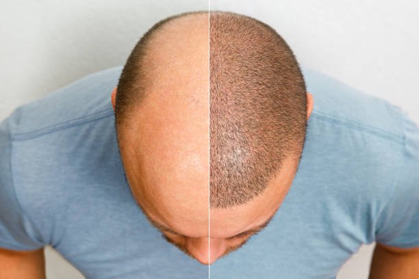 Hair Transplant Treatment In Budaun