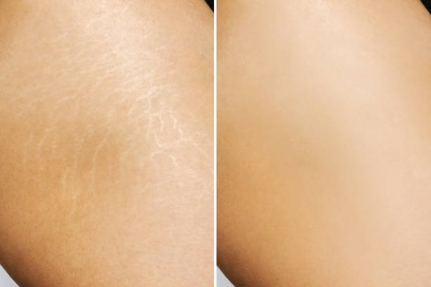 Stretch Marks Treatment in Budaun